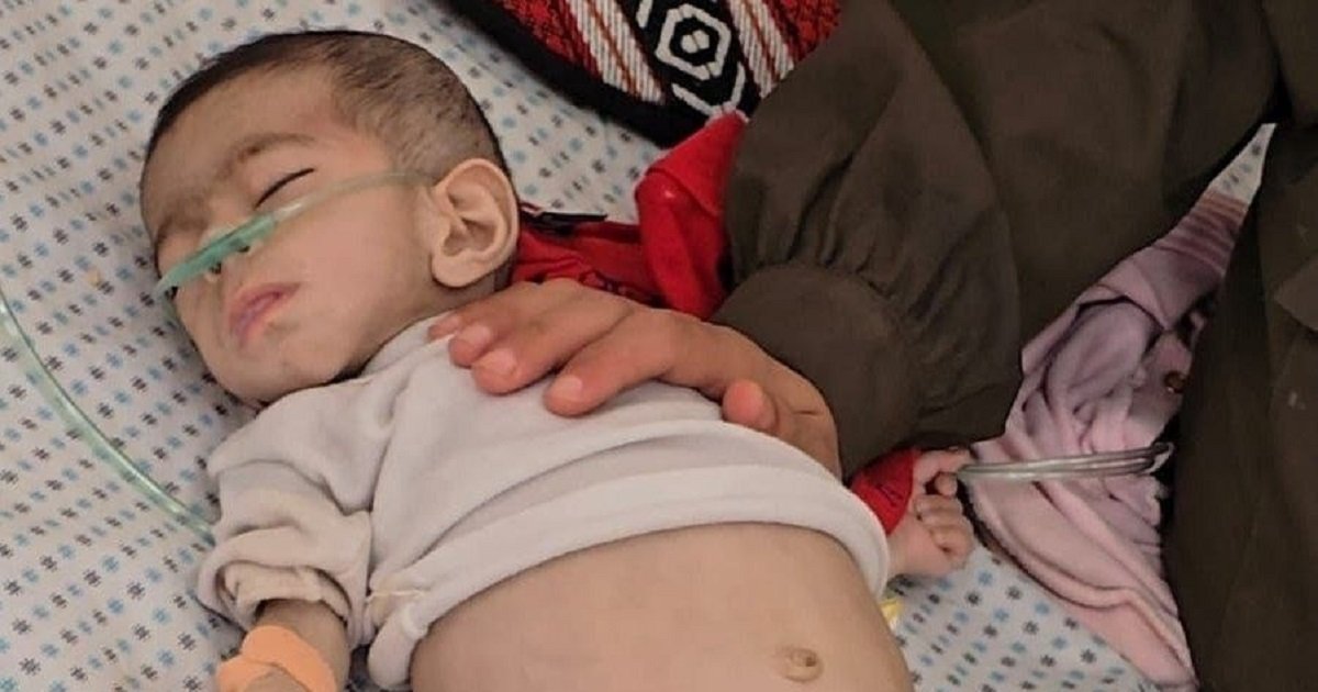 وفاة طفلة في غزة نتيجة المجاعة 
