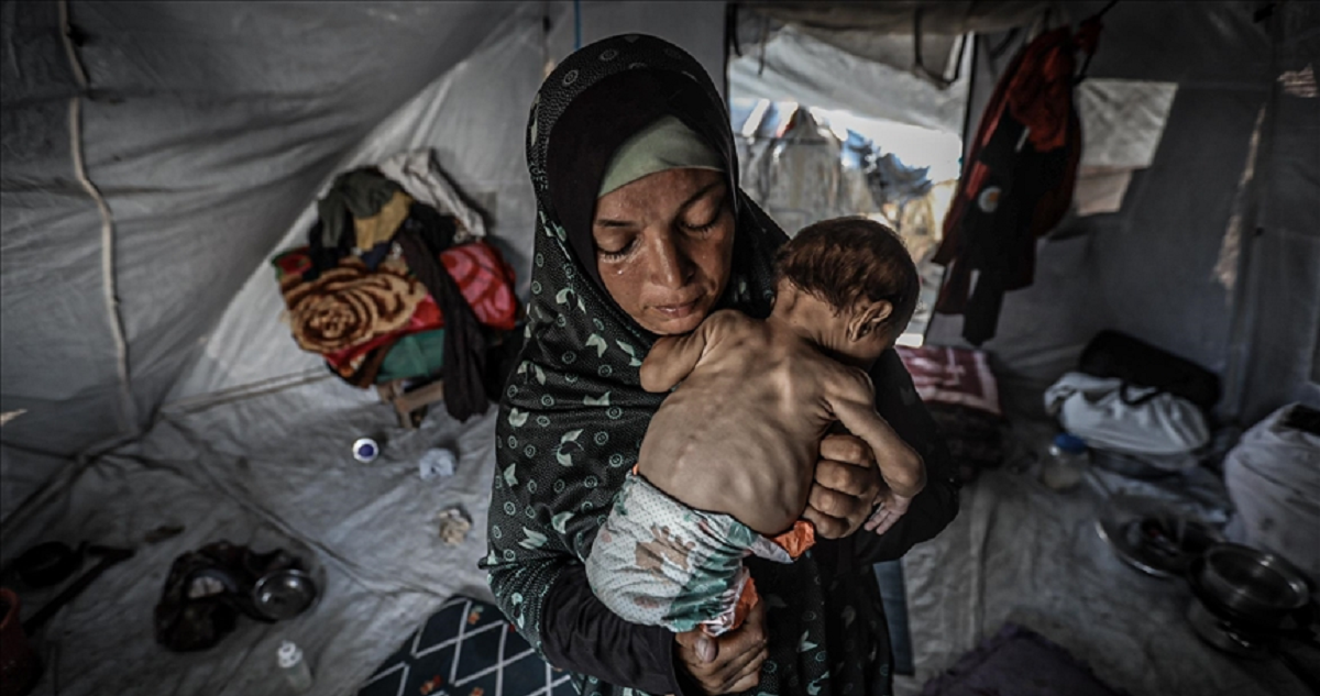 الطفلة مسك.. جسد صغير يتآكل بصمت في غزة المجوّعة 