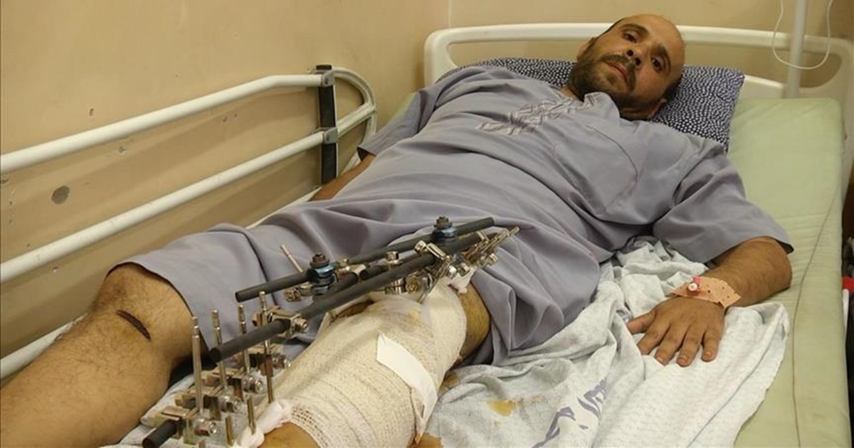 تقرير : مواطنون يتعايشون مع ألم دائم.. رصاص وشظايا في أجساد جرحى غزة