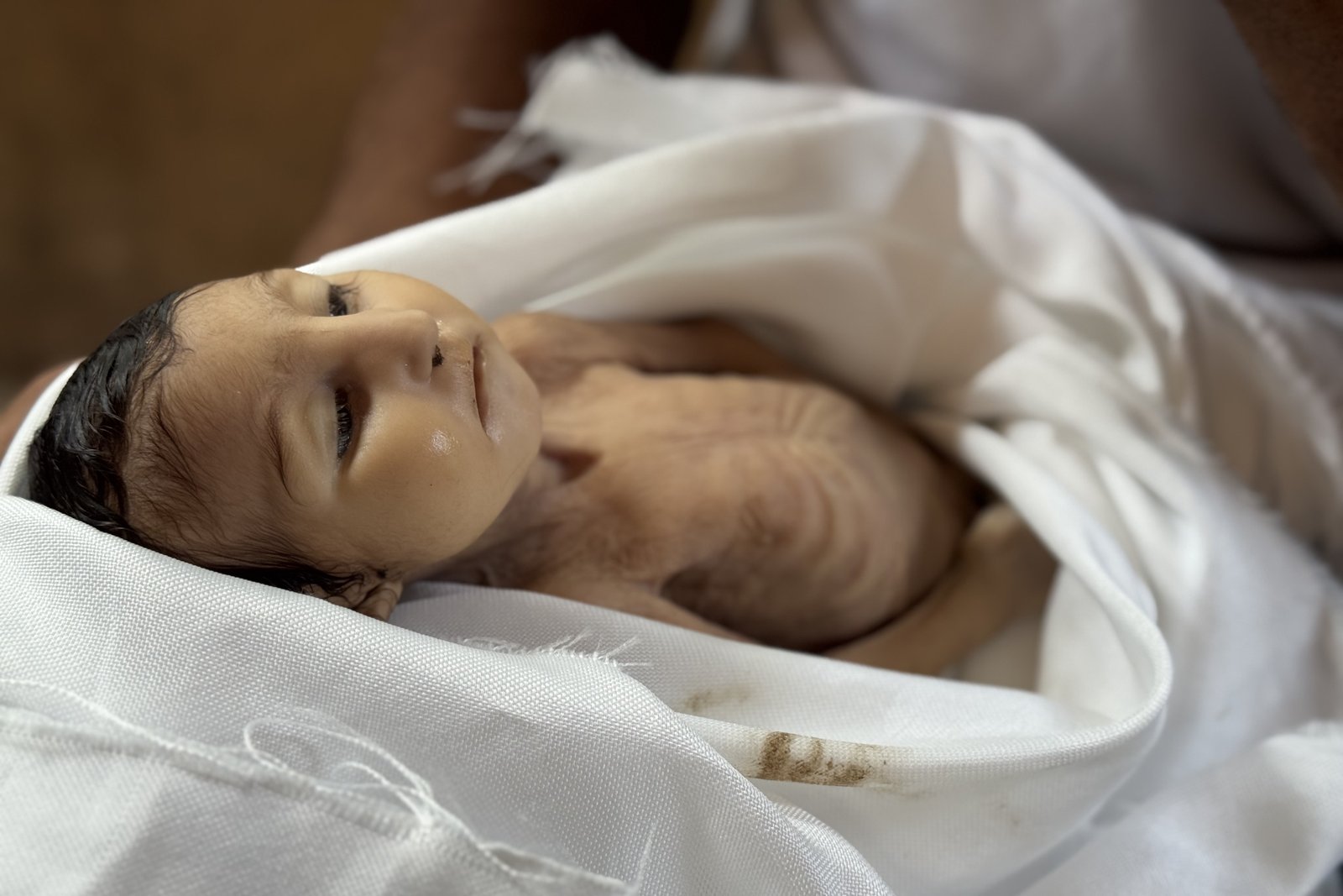  وفاة رضيعة جراء سوء التغذية في خان يونس