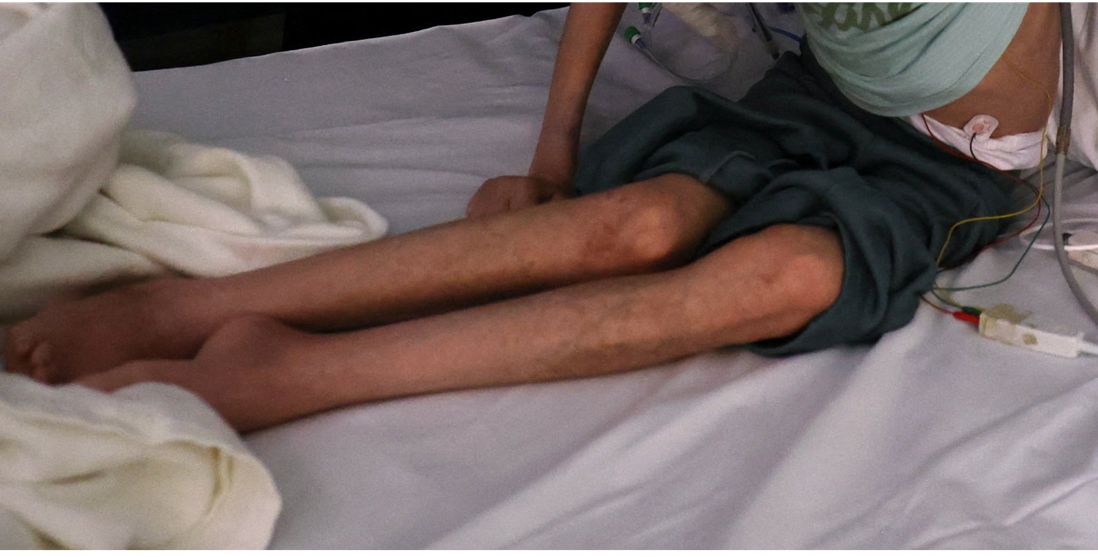 3 وفيات بمتلازمة "غيلان باريه" وتحذيرات من تفشي الشلل الرخو الحاد بغزة