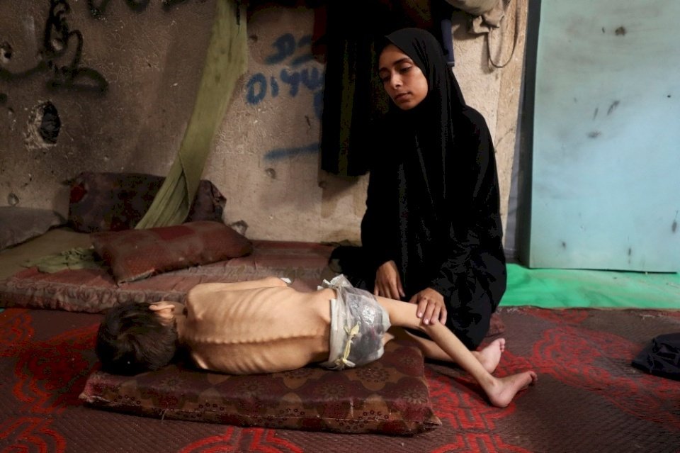 وفاة 5 مواطنين بينهم طفلان نتيجة سوء التغذية والمجاعة في غزة