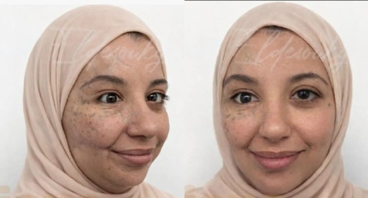 سيدة غزية  تروي كيف  استعادت وجهها بعد الحرب